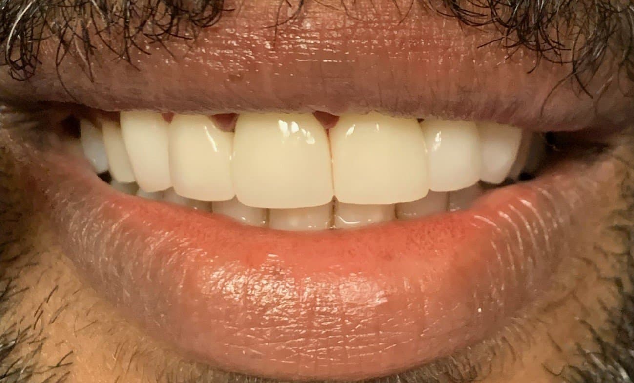 Case 1, after treatment at Johns Creek Family Dentistry