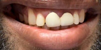 Case 1, before treatment at Johns Creek Family Dentistry