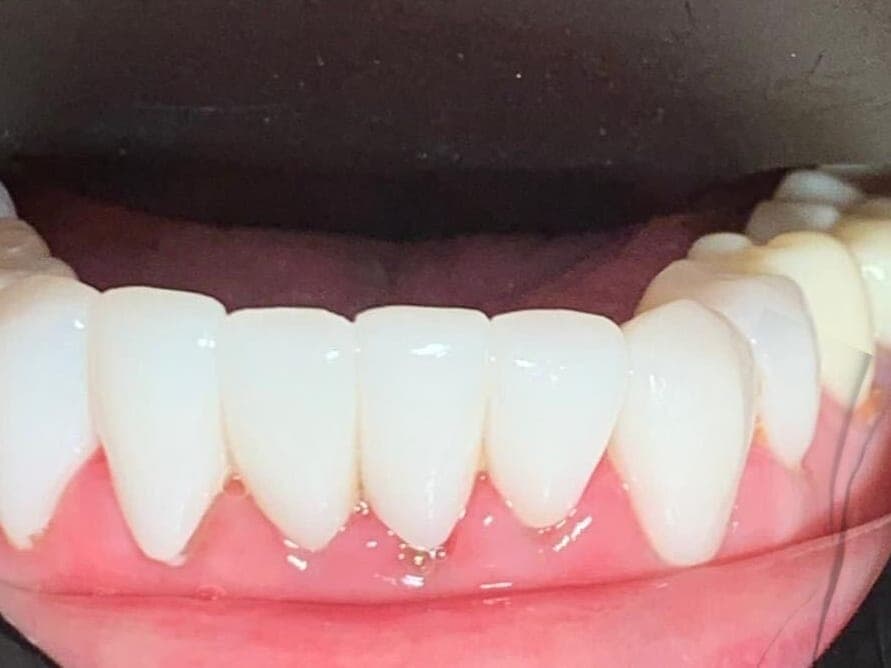 Case 10, after treatment at Johns Creek Family Dentistry