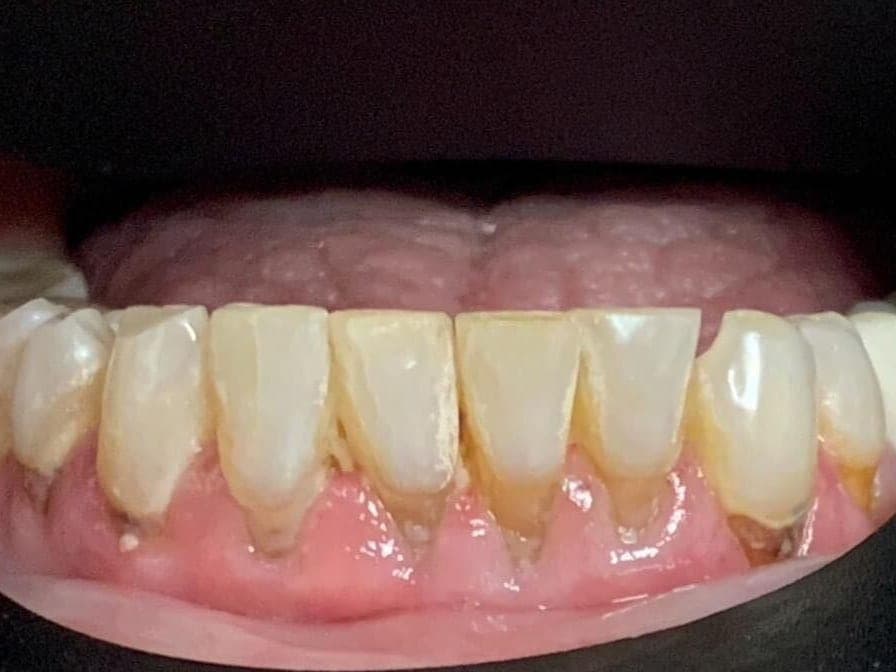 Case 10, before treatment at Johns Creek Family Dentistry
