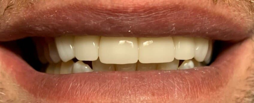 Case 2, after treatment at Johns Creek Family Dentistry