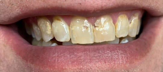 Case 2, before treatment at Johns Creek Family Dentistry