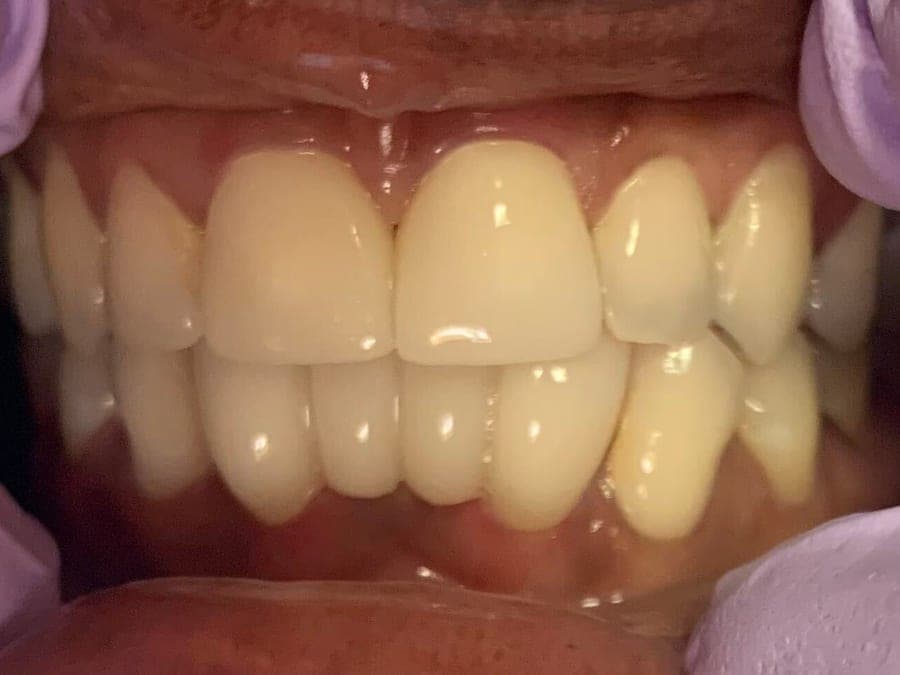 Case 3, after treatment at Johns Creek Family Dentistry