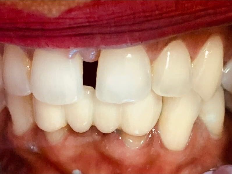 Case 3, before treatment at Johns Creek Family Dentistry