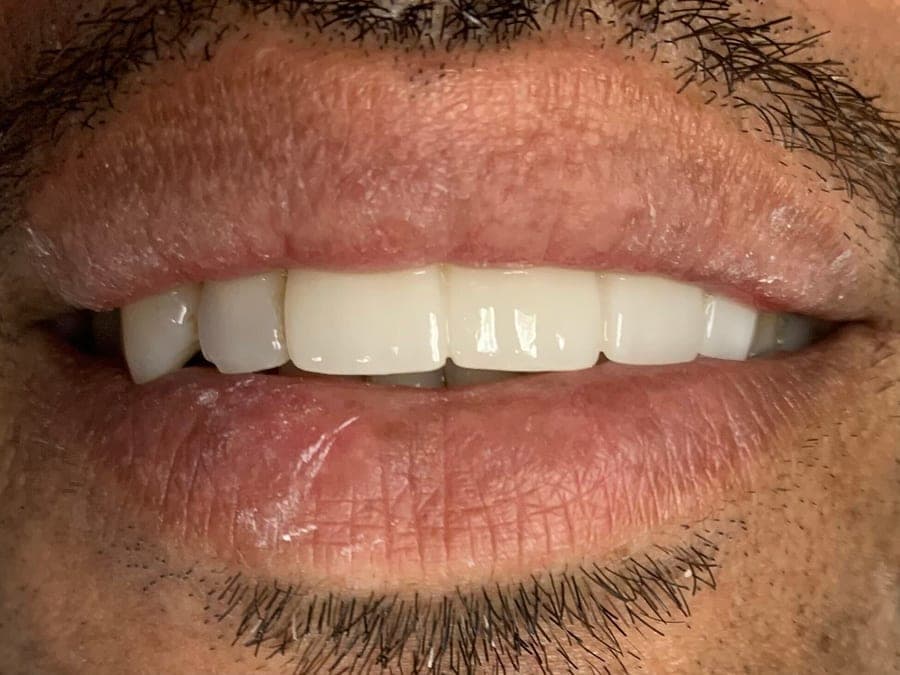 Case 4, after treatment at Johns Creek Family Dentistry