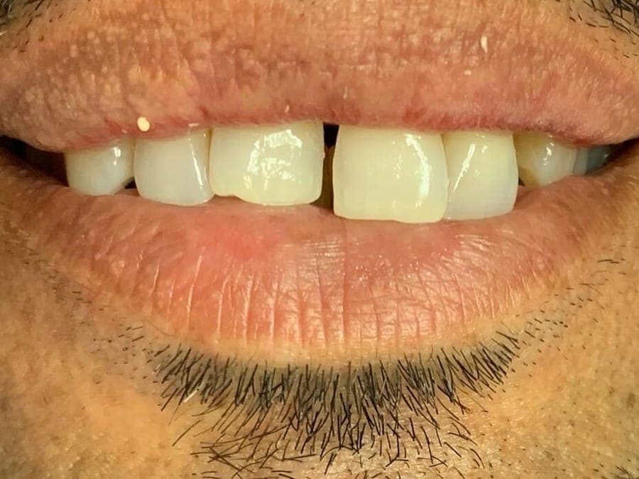 Case 4, before treatment at Johns Creek Family Dentistry