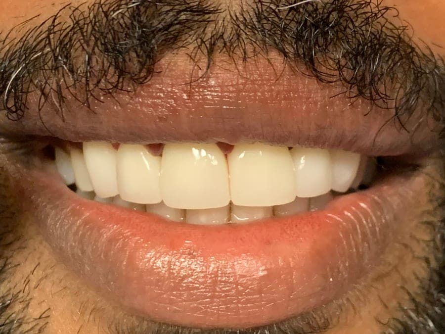 Case 5, after treatment at Johns Creek Family Dentistry