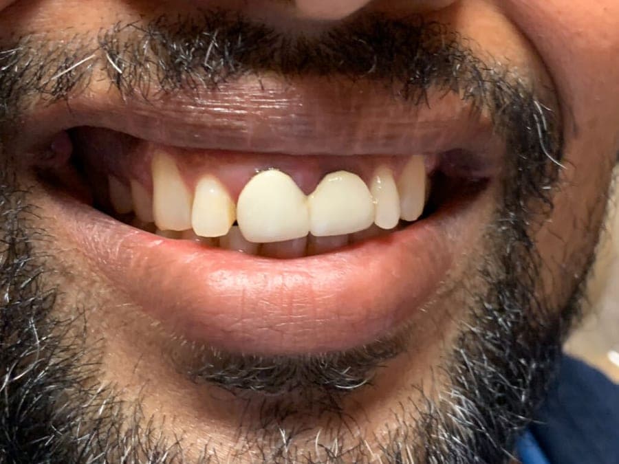 Case 5, before treatment at Johns Creek Family Dentistry