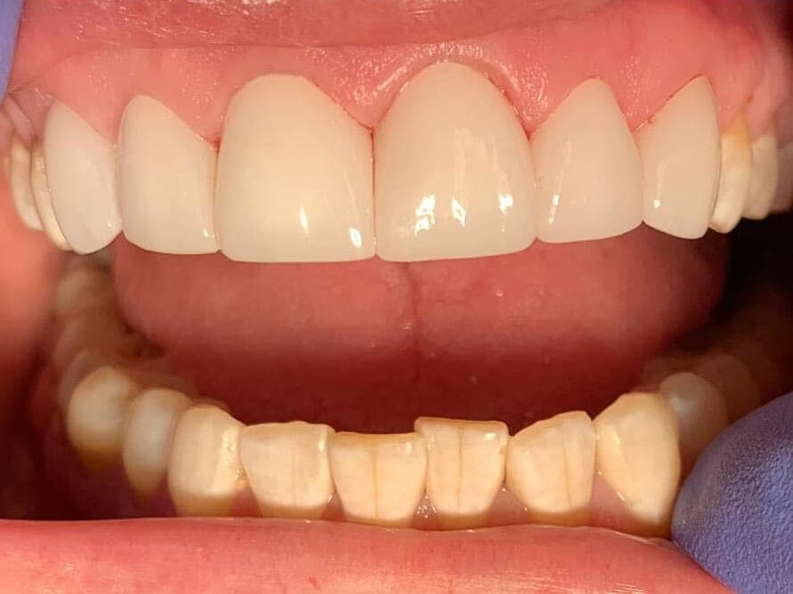 Case 6, after treatment at Johns Creek Family Dentistry