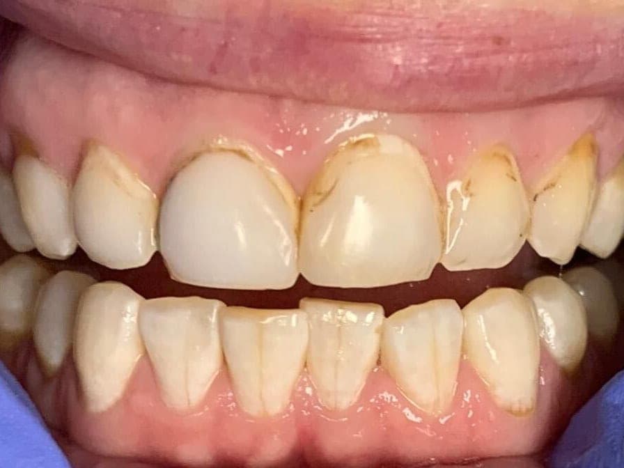Case 6, before treatment at Johns Creek Family Dentistry