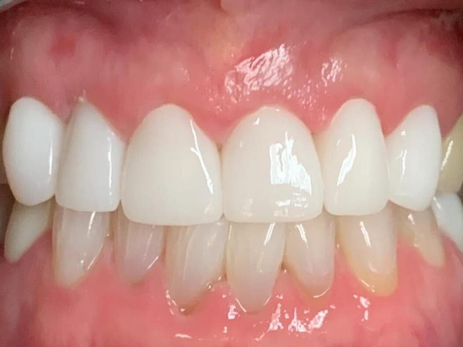 Case 7, after treatment at Johns Creek Family Dentistry