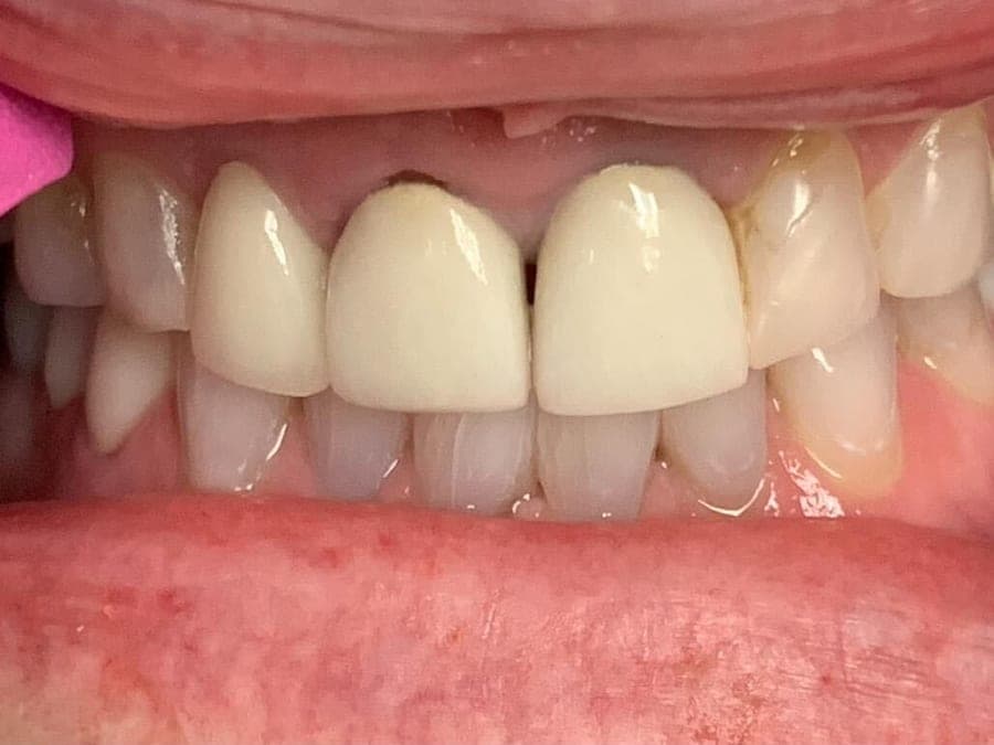 Case 7, before treatment at Johns Creek Family Dentistry