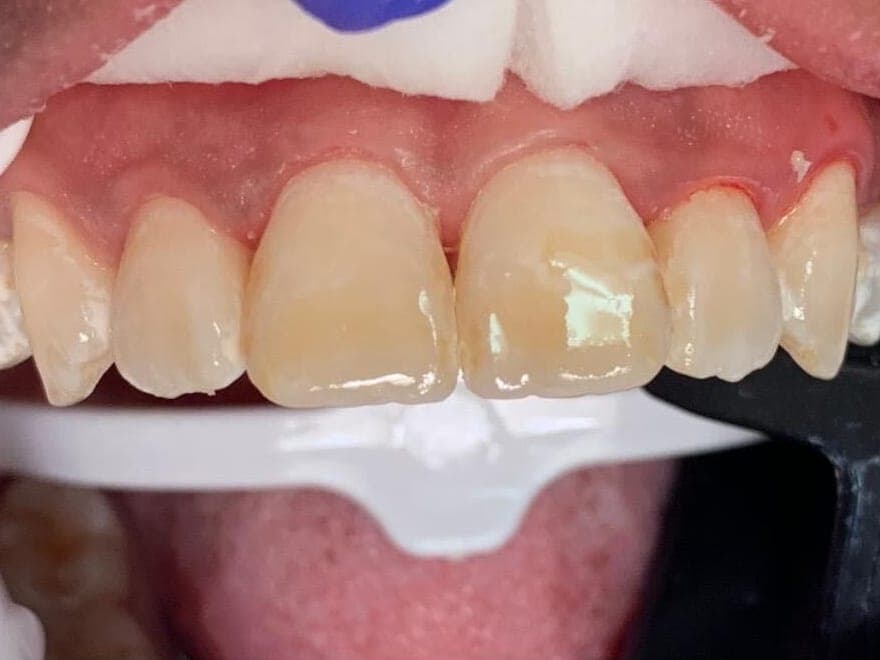 Case 8, after treatment at Johns Creek Family Dentistry