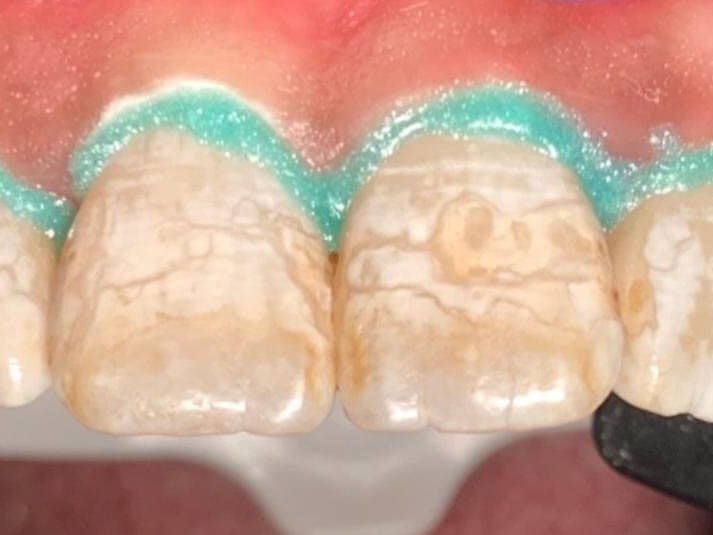 Case 8, before treatment at Johns Creek Family Dentistry