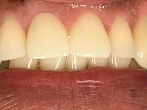 Case 9, after treatment at Johns Creek Family Dentistry