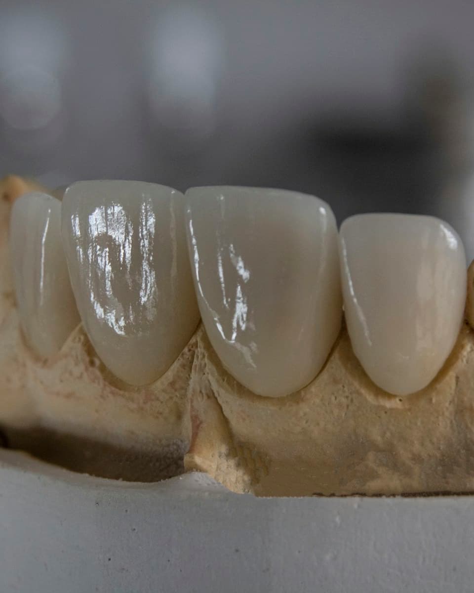 Four porcelain crowns seated on a plaster dental model