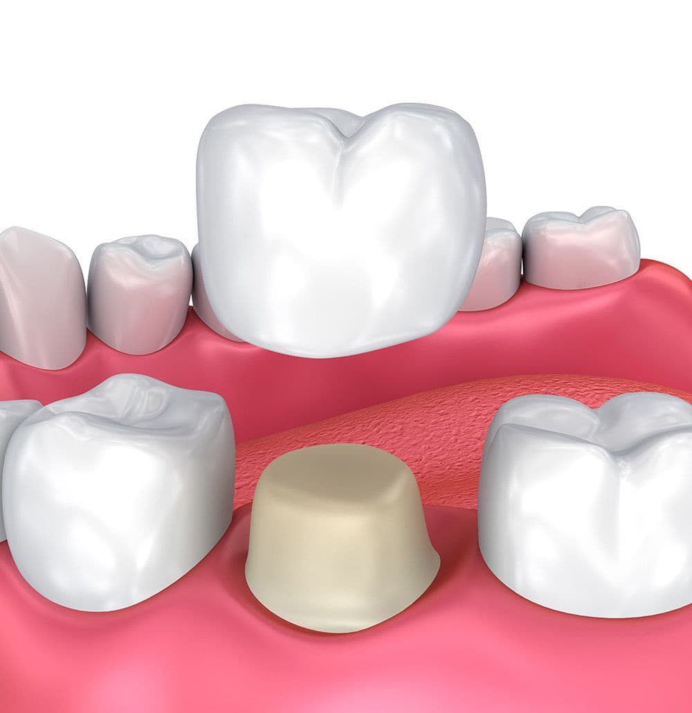 Cavities or Decay treatments at Johns Creek Family Dentistry