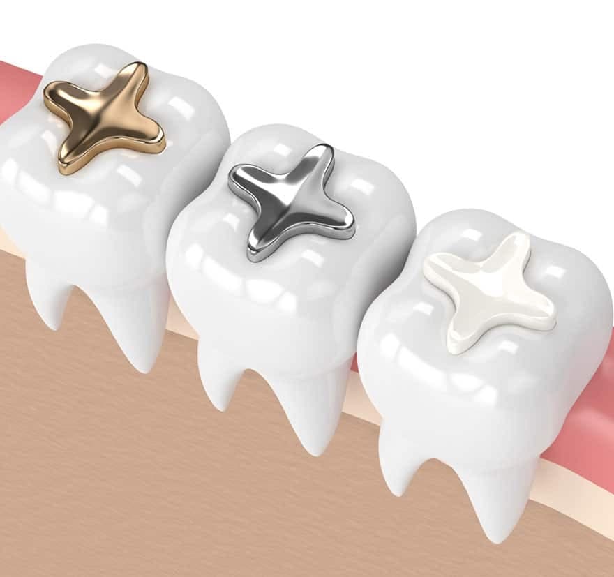 Cavities or Decay treatments at Johns Creek Family Dentistry