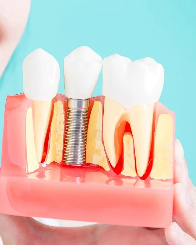 A hand holding a cutaway model of a dental implant between two natural teeth