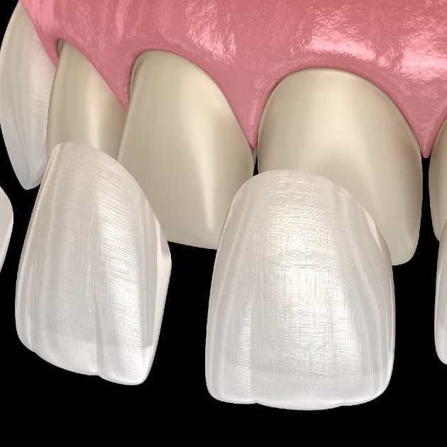 An illustration of thin porcelain veneers being placed over the front teeth