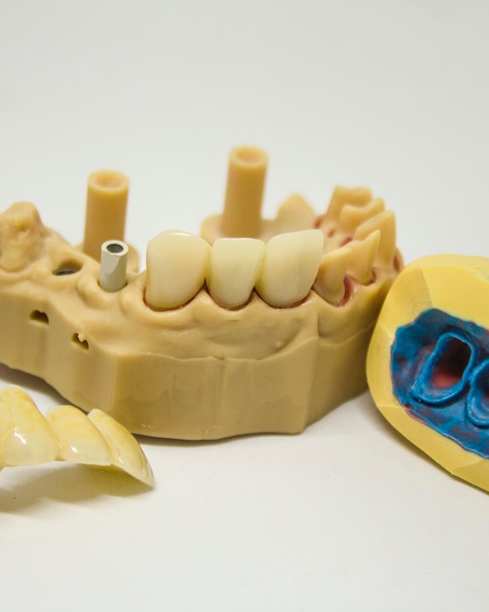 A lab model of a lower jaw with implant posts beside a denture framework and impression