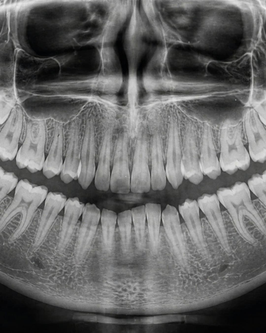 A digital panoramic x-ray showing the full upper and lower jaw