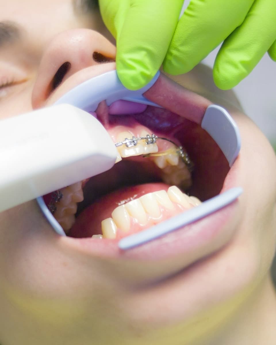 A patient's mouth held open with a cheek retractor while a suction tip rests inside